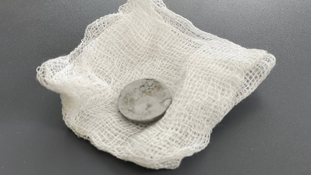 У Львові хірурги дістали зі стравоходу 2-річної дитини батарейку, з якою вона жила всю зиму